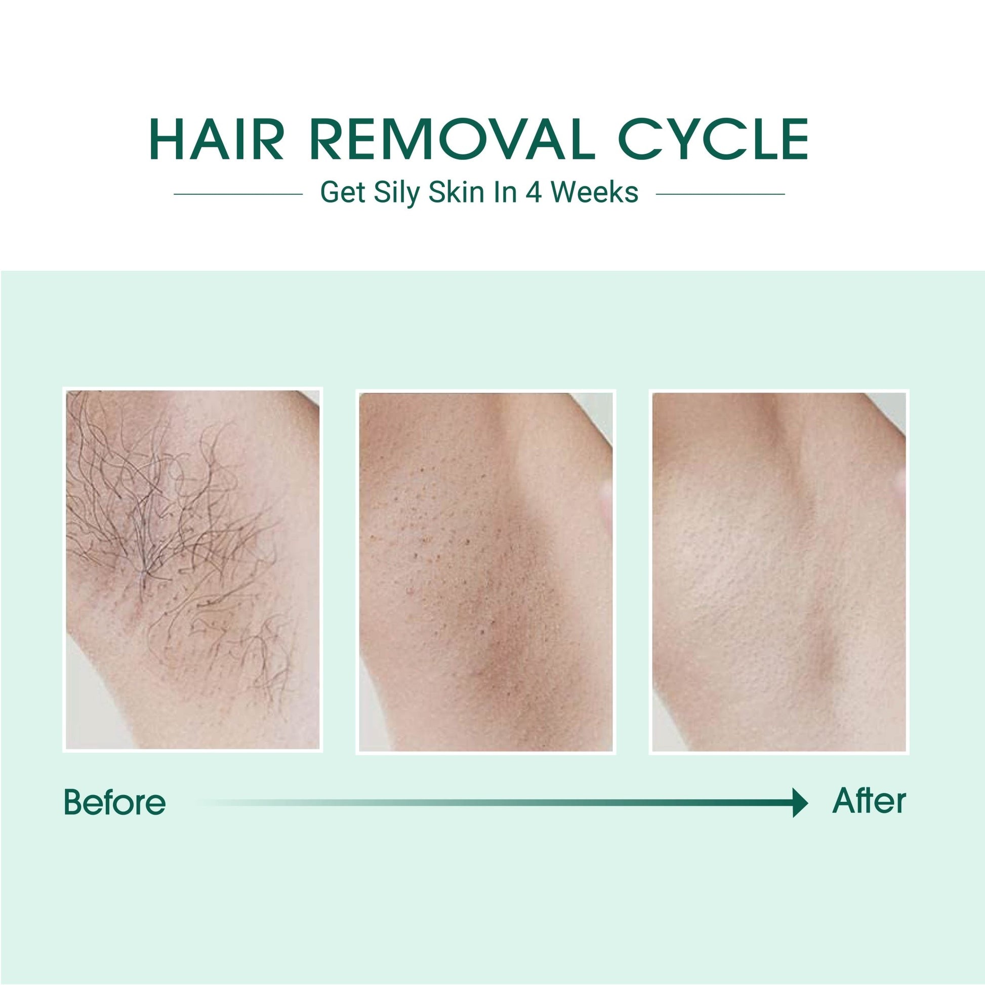Laser IPL Hair Removal - aydens bidness